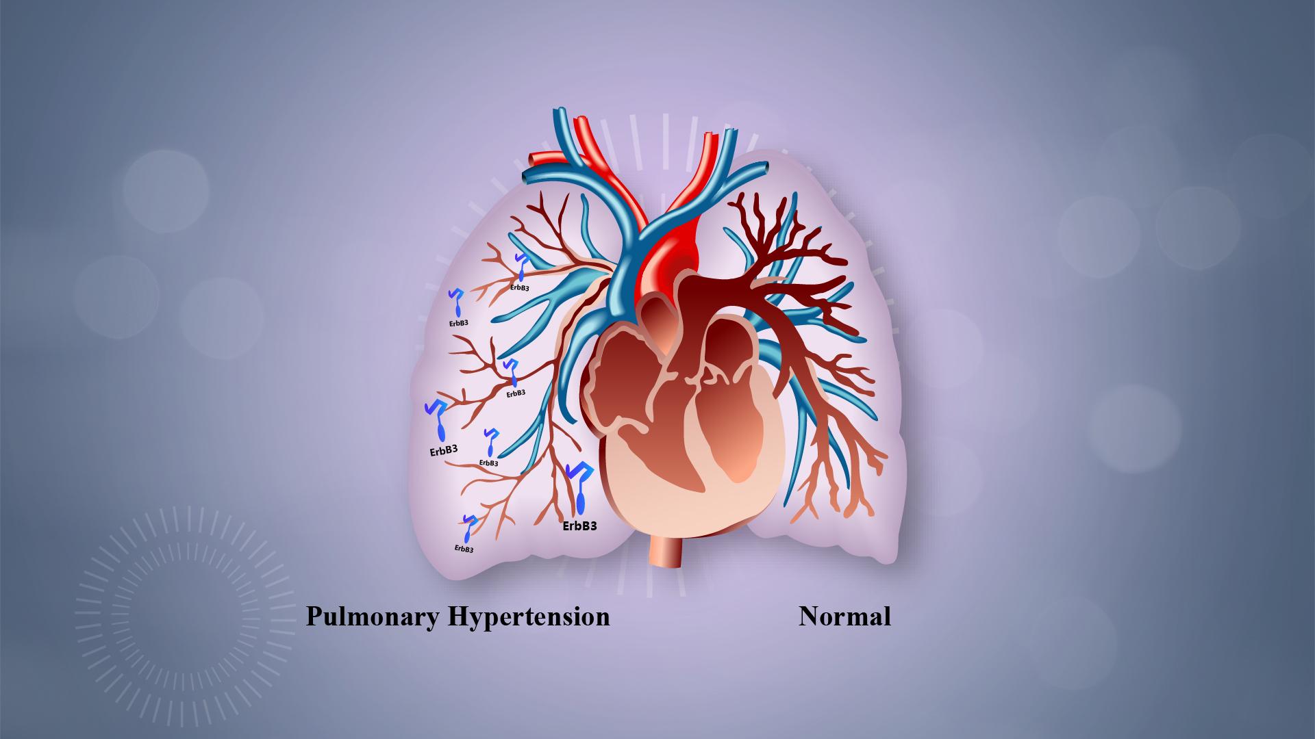 Researchers reveal new approach to treat pulmonary hypertension